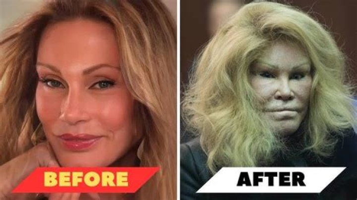 Carly Simon | Wrong With Face? Plastic Surgery Before And After