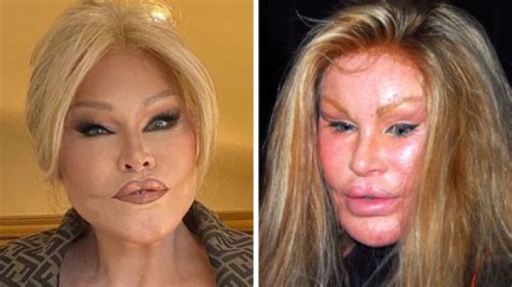 Cat Woman Plastic Surgery Before And After | Why Jocelyn Wildenstein Face Looks So Different