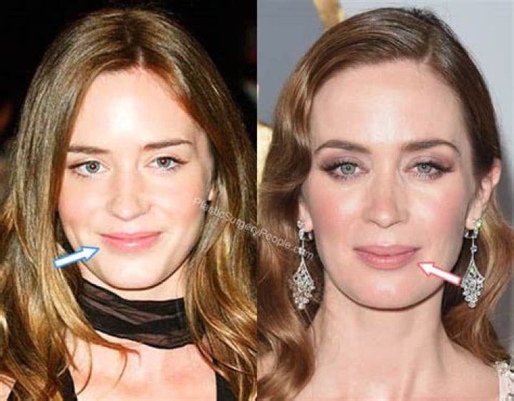 Emily Blunt Botox And Nose Job | Did She Underwent Surgery