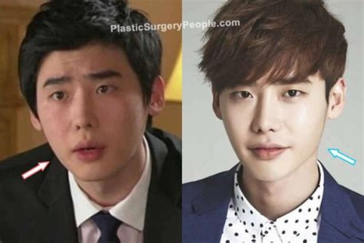 Lee Jong Suk | Before Plastic Surgery? Wrong With His Face?