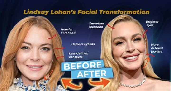 Lindsay Lohan Face Lift And Nose Job | Before And After Photos