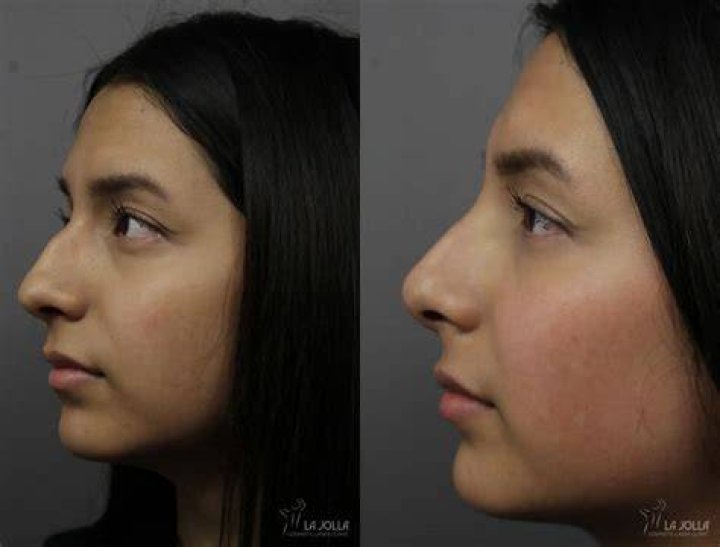 Riz Ahmed Nose Job | Before And After Photos