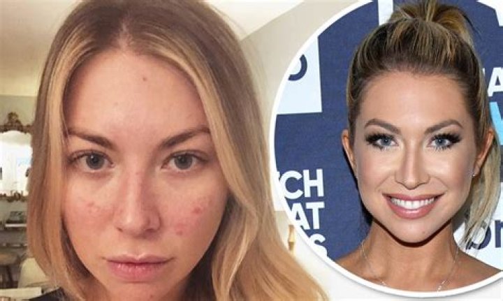 Stassi Schroeder | Plastic Surgery And Breast Reduction Surgery