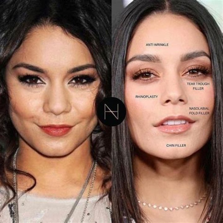 Vanessa Hudgens Botox | Before And After Photos 2023