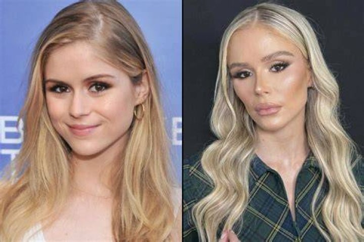 Yellowstone: Did Angela Get Lips Surgery | Before And After